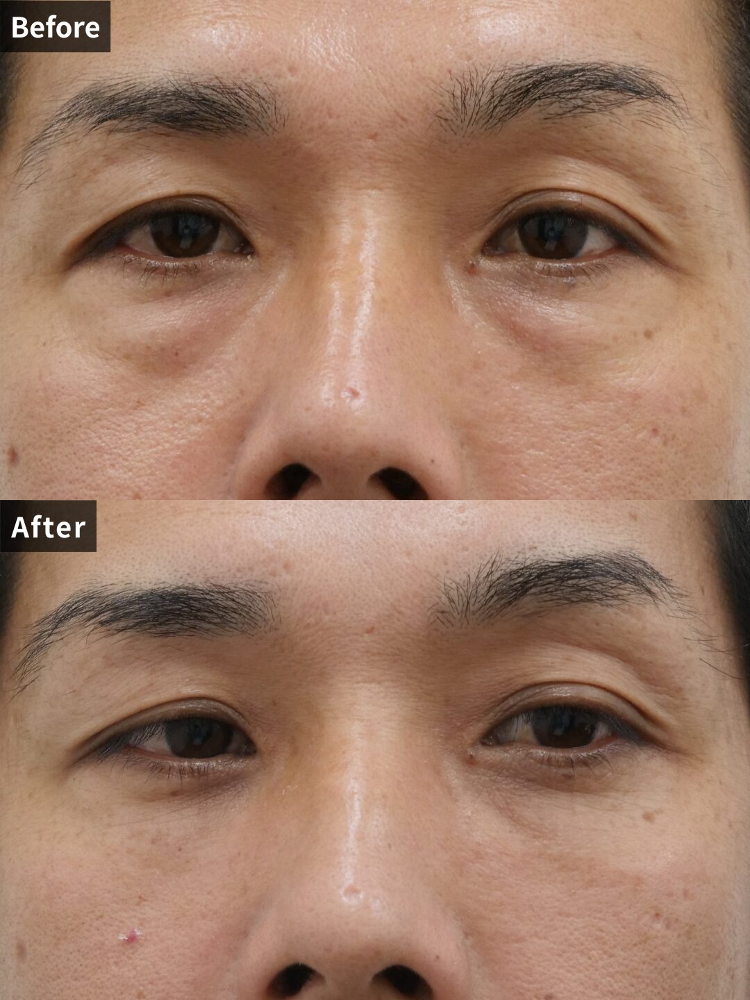 ＃125（30代 男性）目の下スリーミックス法