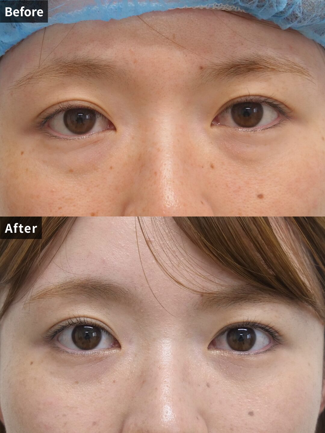 ＃134（30代 女性）目の下スリーミックス法