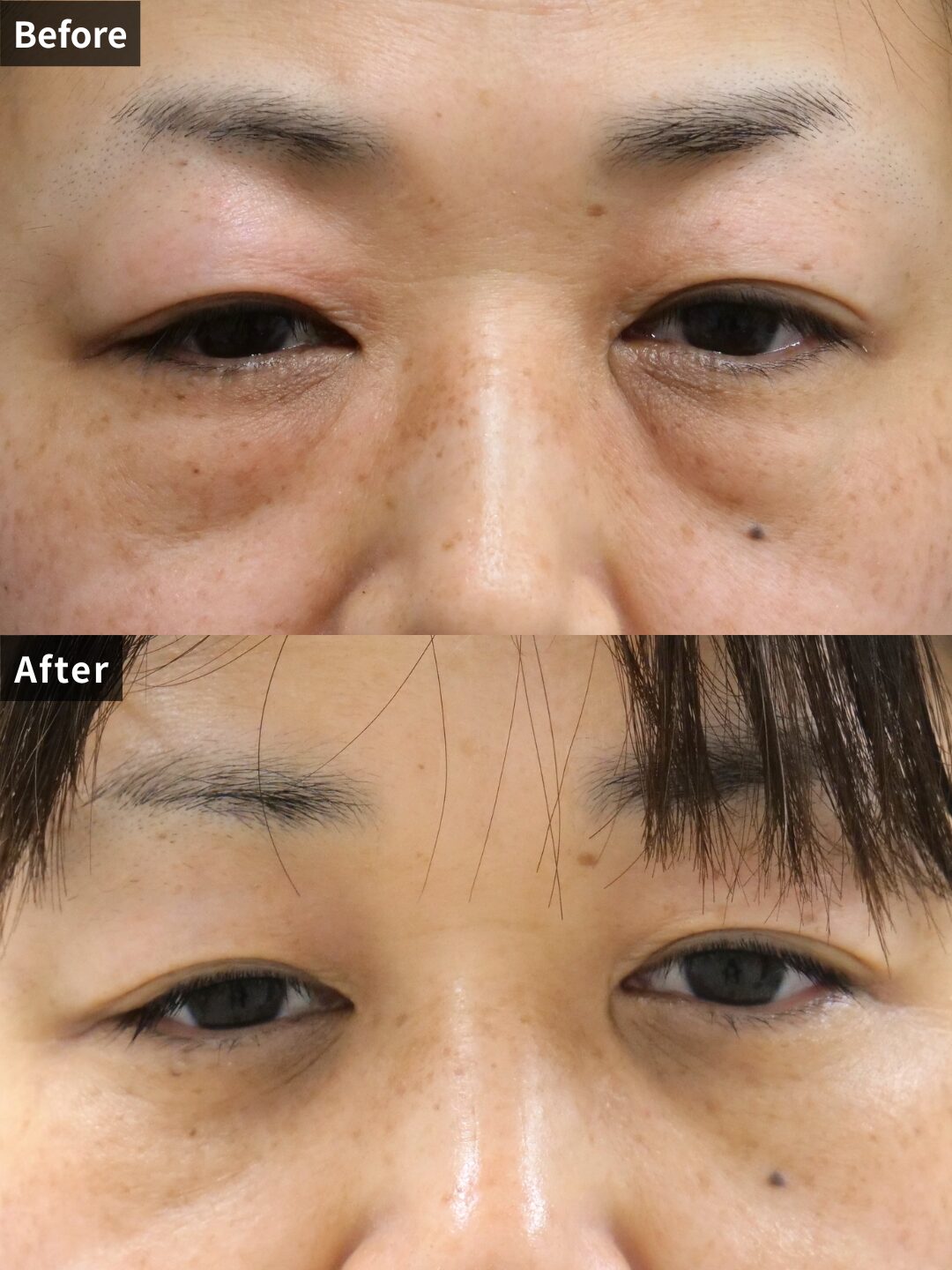 ＃136（50代 女性）目の下スリーミックス法＋目の下リードファインリフト