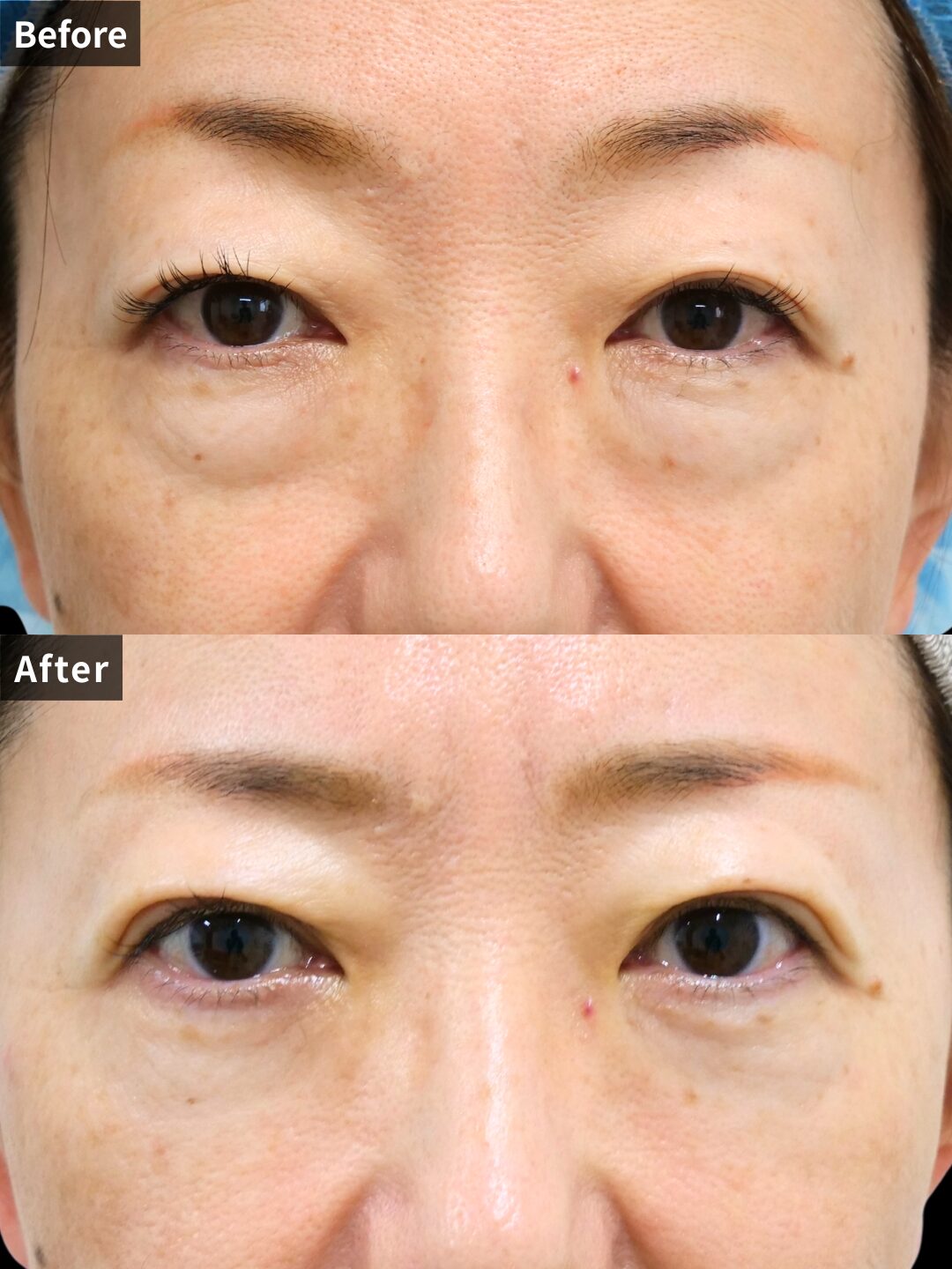 ＃141（50代 女性）目の下スリーミックス法+目の下リードファインリフト