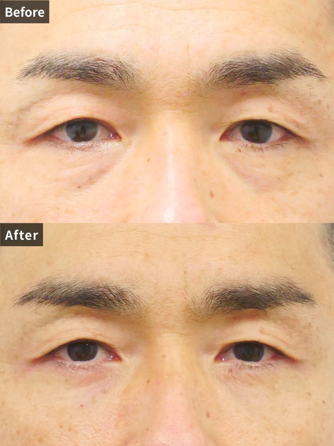 ＃145（40代 男性）目の下スリーミックス法+目の下リードファインリフト