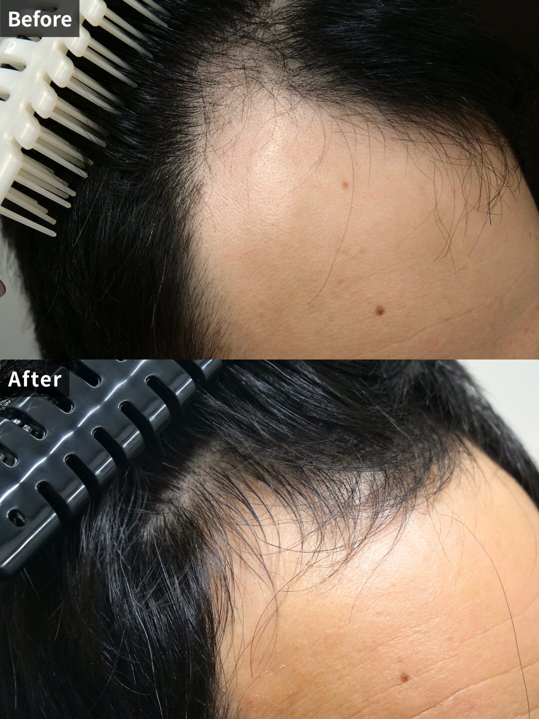＃201（30代 男性）AGA治療