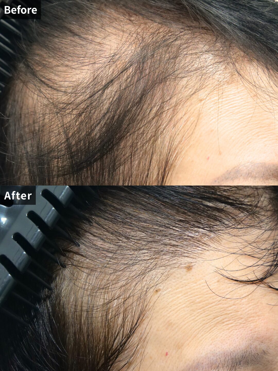 ＃202（60代 女性）女性の薄毛FAGA治療