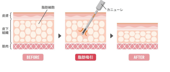 脂肪吸引の方法