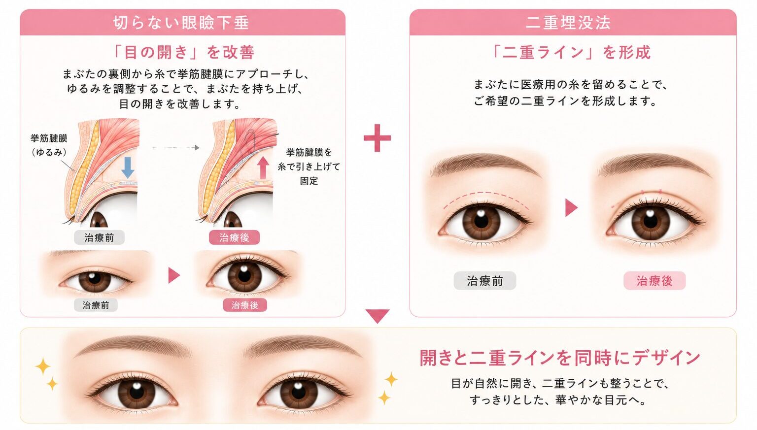 眼瞼下垂と二重埋没法の併用治療