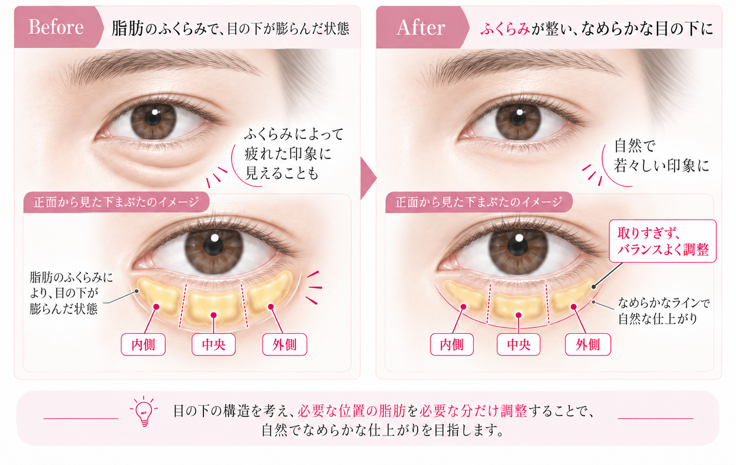 目の下の脂肪を整えるビフォーアフター