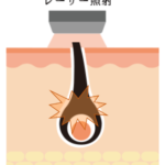 静岡・三島で医療脱毛を始めるなら橋本クリニックっ！