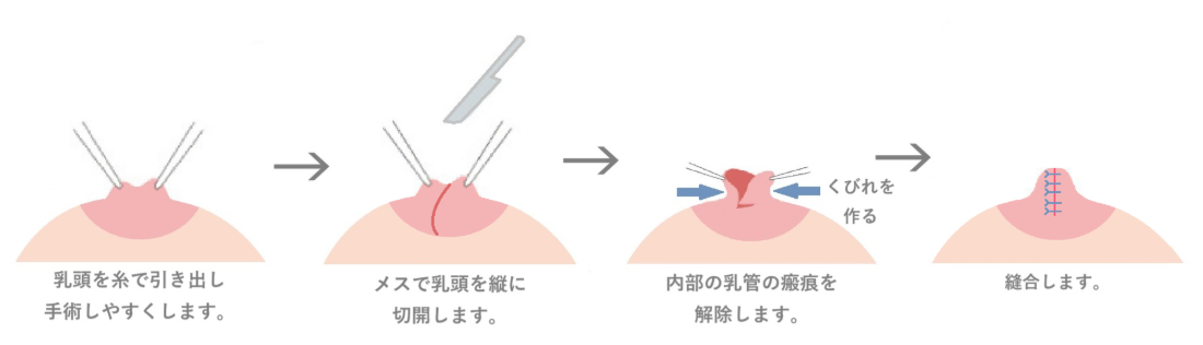 シリコンバック挿入している方に行った陥没乳頭手術の紹介です。