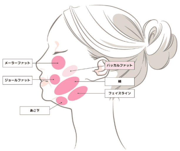 顔の脂肪吸引の部位