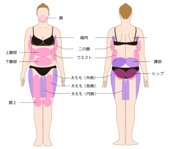 体の脂肪吸引の部位