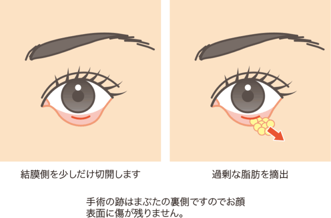 目の下脂肪取りの説明