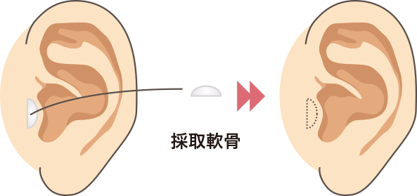鼻尖形成（耳介軟骨移植）の方法