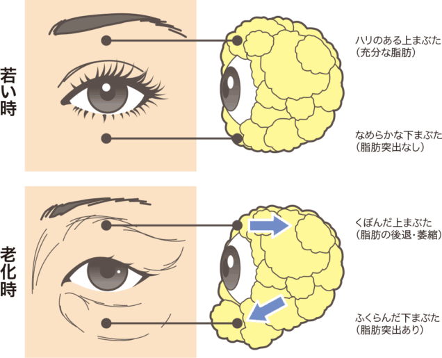 下まぶた老化のメカニズムについて説明