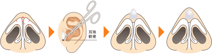 鼻尖形成（耳介軟骨移植）の説明