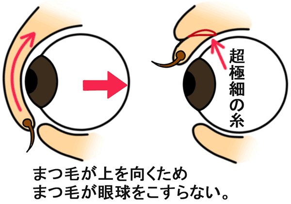 切らない逆さまつ毛治療の説明
