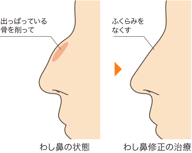 わし鼻修正(ハンプ削り)の説明