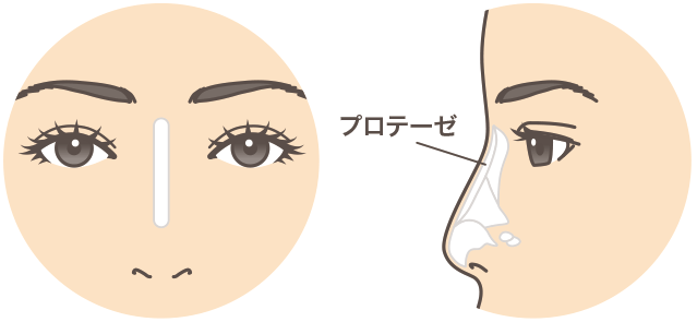 隆鼻術プロテーゼの説明