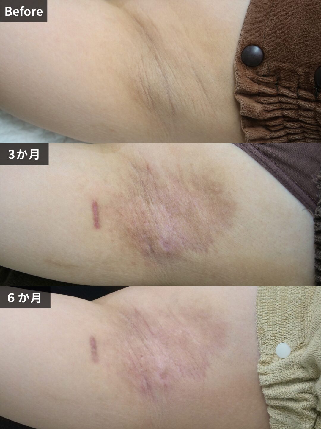 ＃212（30代 女性）わきがスリーミックス法