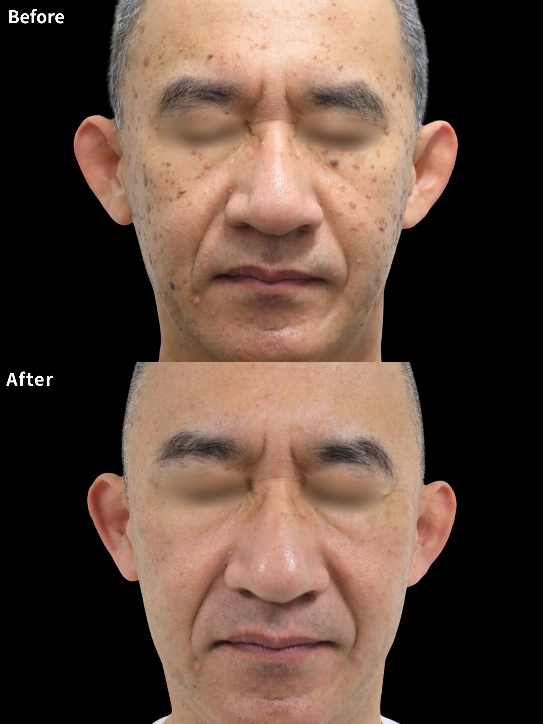 ＃276（50代 男性）ほくろ・いぼ除去