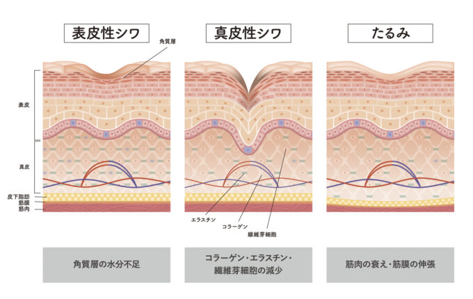 皮膚がたるむメカニズム