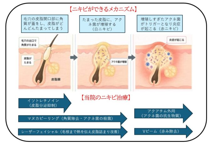 ニキビができるメカニズム