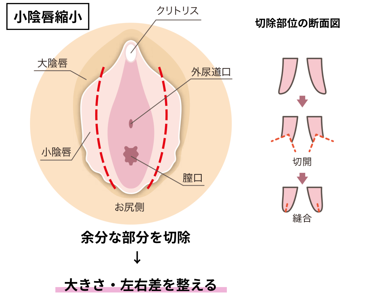 小陰唇縮小図解