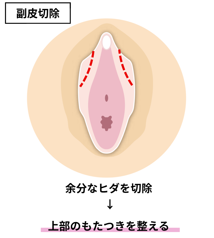 副皮切除図解
