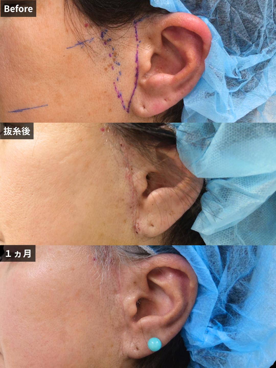 ＃328（60代 女性）ミニ+こめかみリフト（傷跡の様子）
