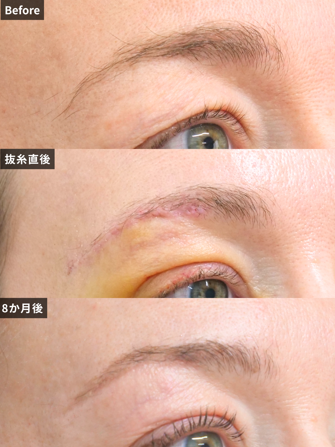 ＃335（50代 女性）眉毛下切開法の症例 2