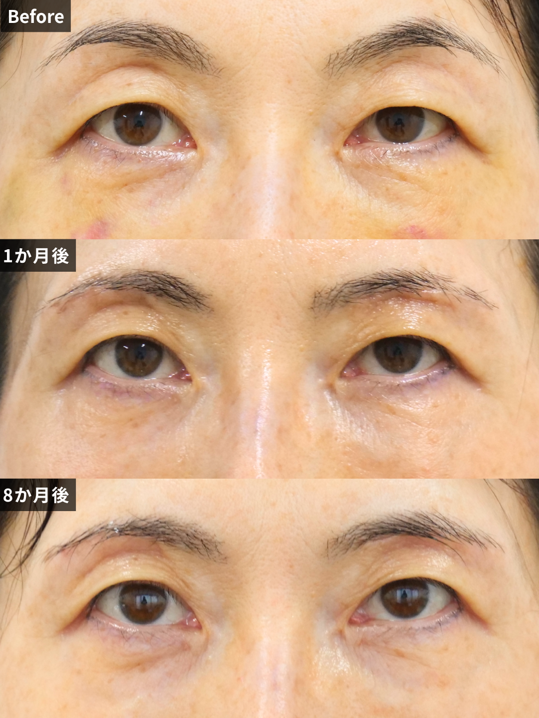 ＃336（60代 女性）眉毛下切開法