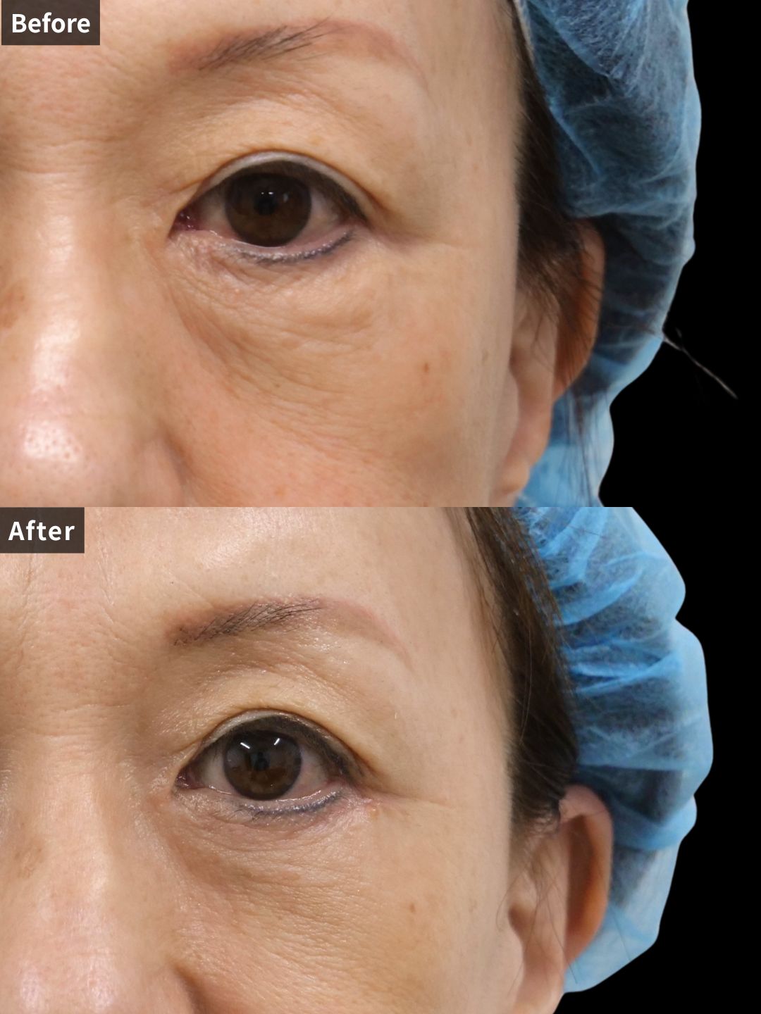 ＃370（60代  女性）切る目の下たるみ取り