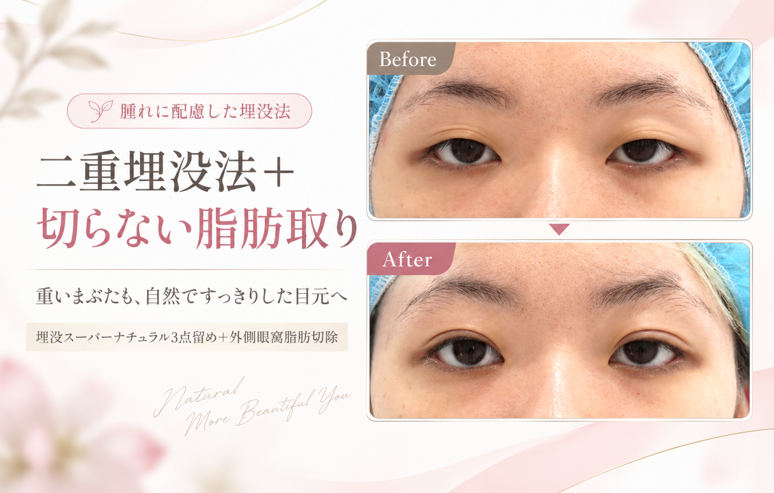 重いまぶたも自然な二重に！埋没スーパーナチュラル3点留め＋切らない脂肪取りの症例